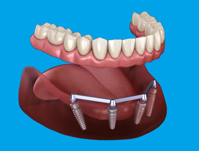implant zęba Łódź - JMC Stomatologia